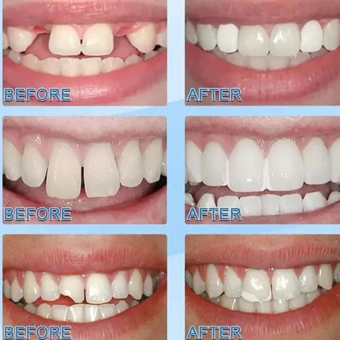 Kelonda™ DIY Tooth Repair Kit