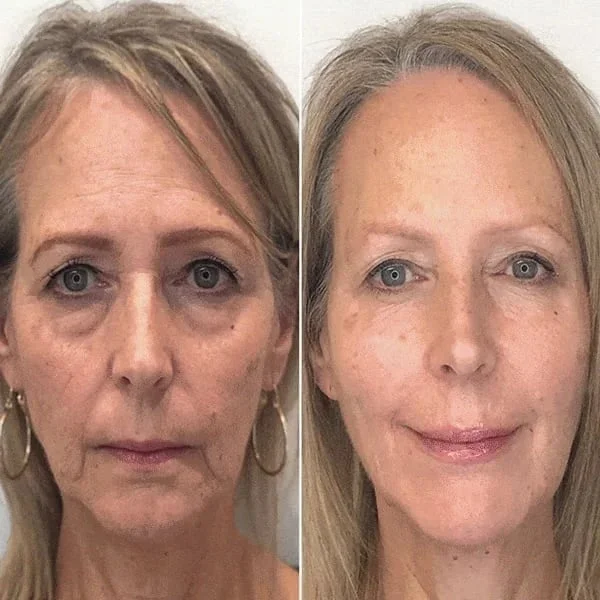 Kelonda™ Botox Face Serum