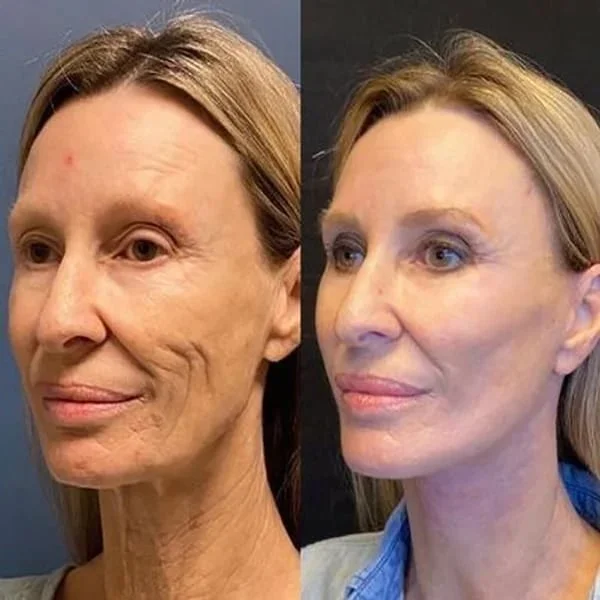 Kelonda™ Botox Face Serum