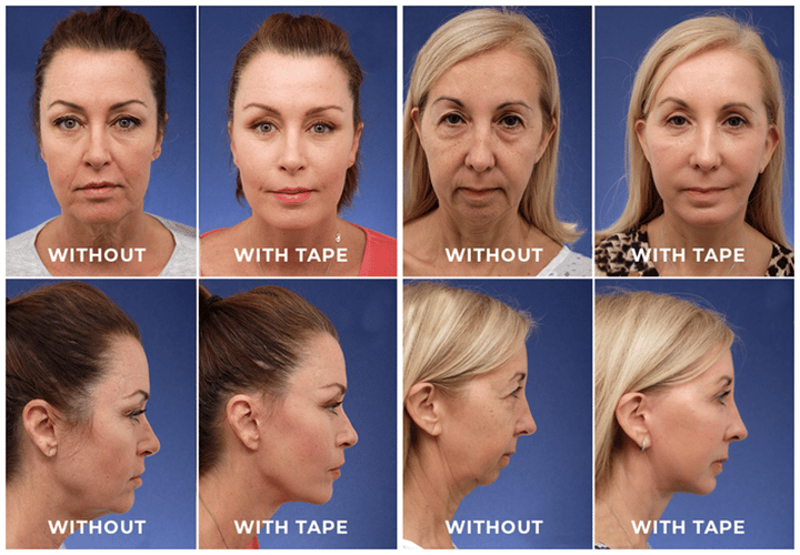 Kelonda™ Invisible Face Lifter Tape