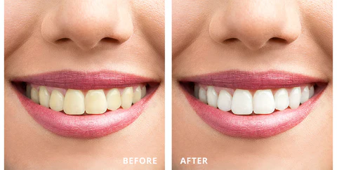 Kelonda™ Whitening Pen