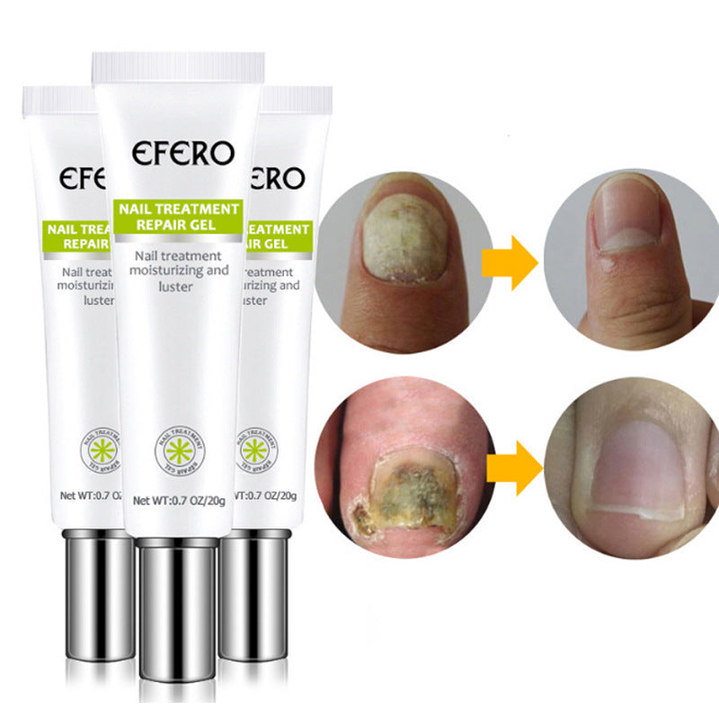 KELONDA™ Anti-Fungal Nail Repair Gel | Buy 1 Get 1 FREE