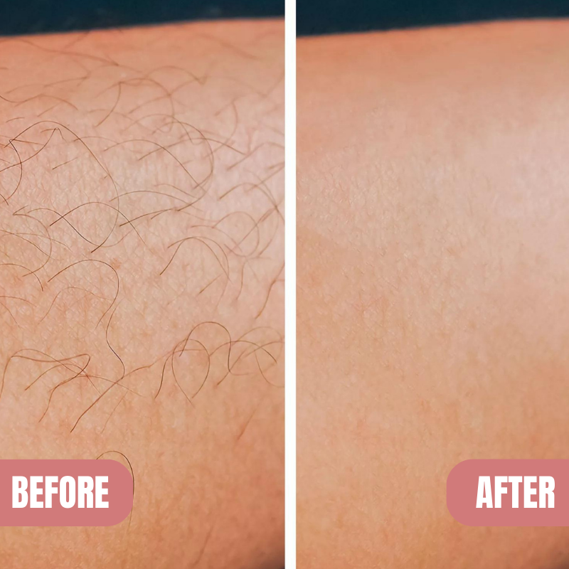 KELONDA™ Pain-Free Hair Removal Spray | Buy 1 Get 1 FREE