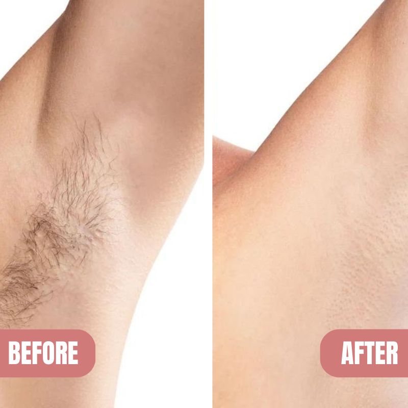 KELONDA™ Pain-Free Hair Removal Spray | Buy 1 Get 1 FREE