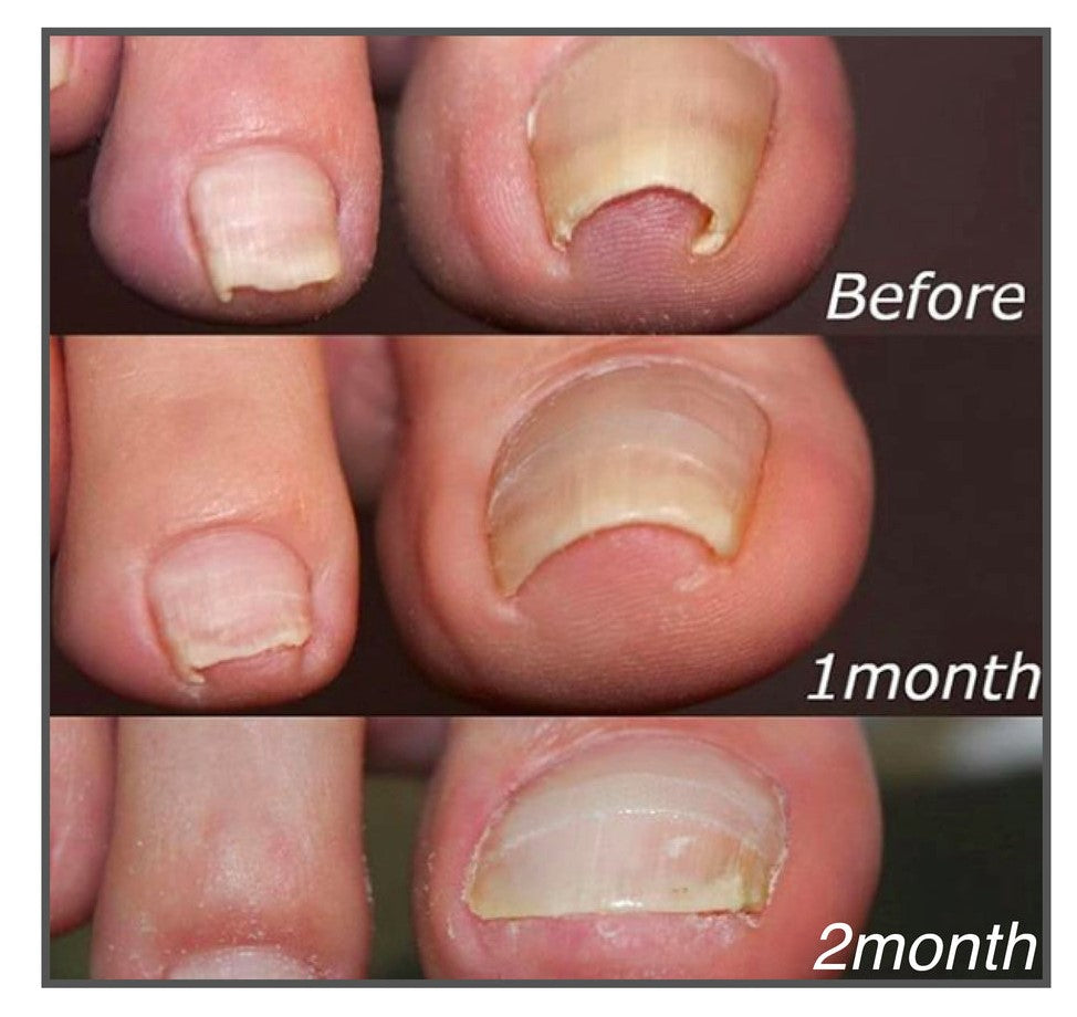 KELONDA™ | Correction patches for beautiful and healthy nails (50 PCS)