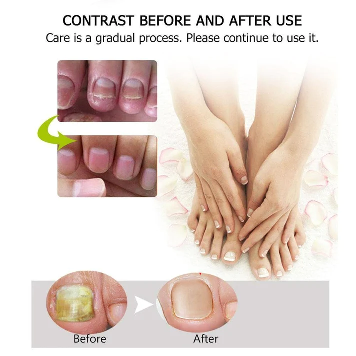 KELONDA™ Anti-Fungal Nail Repair Gel | Buy 1 Get 1 FREE
