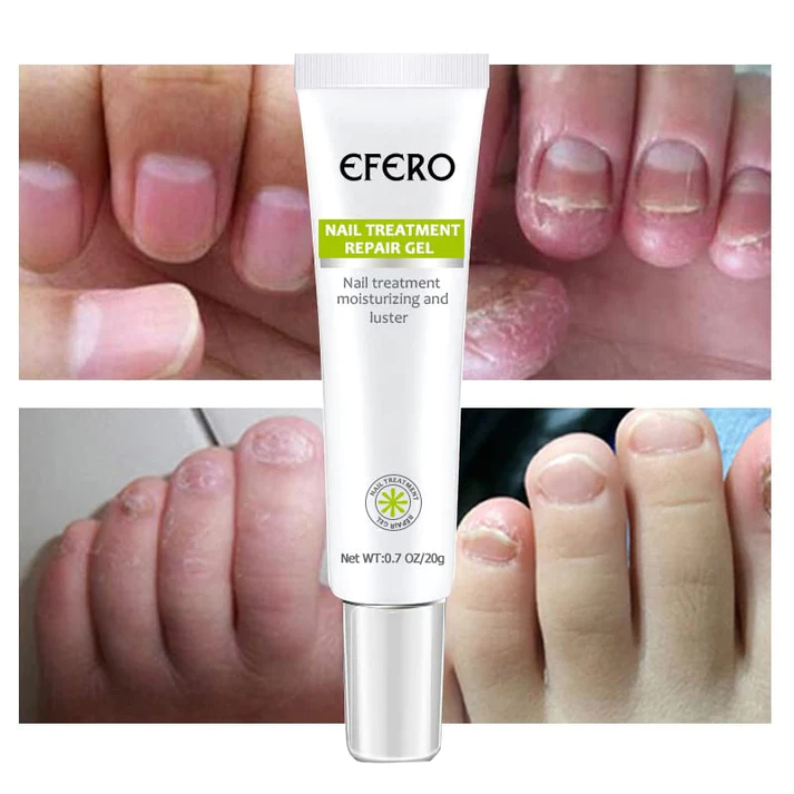 KELONDA™ Anti-Fungal Nail Repair Gel | Buy 1 Get 1 FREE