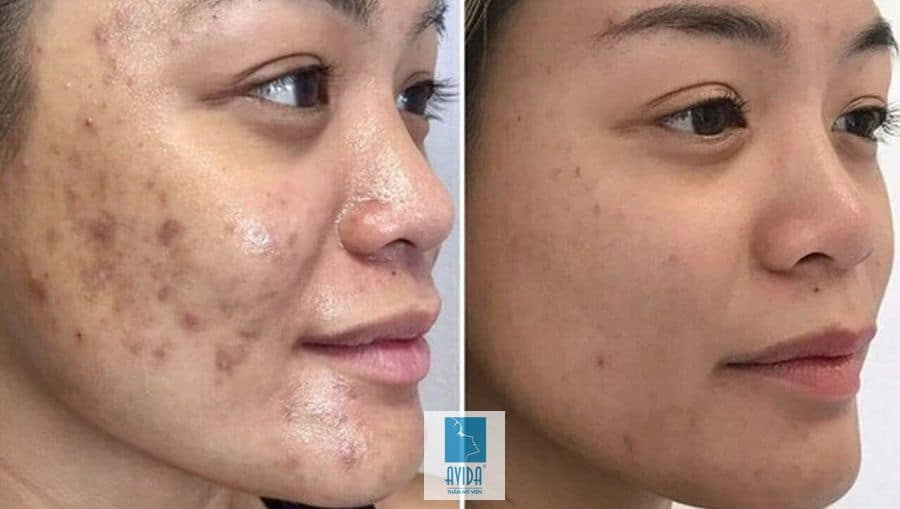 KELONDA™ SKIN WHITENING EXFOLIATING GEL | Buy 1 Get 1 Free