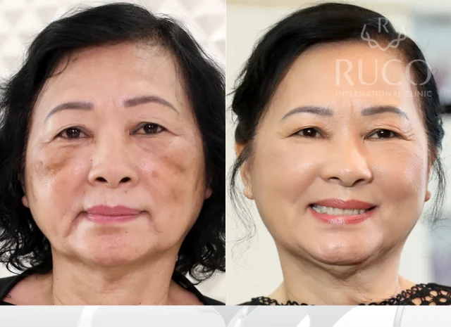 KELONDA™ SKIN WHITENING EXFOLIATING GEL | Buy 1 Get 1 Free